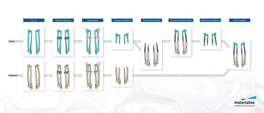 3D Technologies Support World’s First Successful Double Hand and Face Transplant